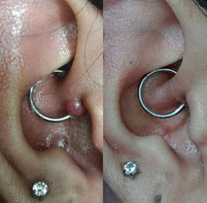 Consultation • Troubleshoot on Problematic Piercing